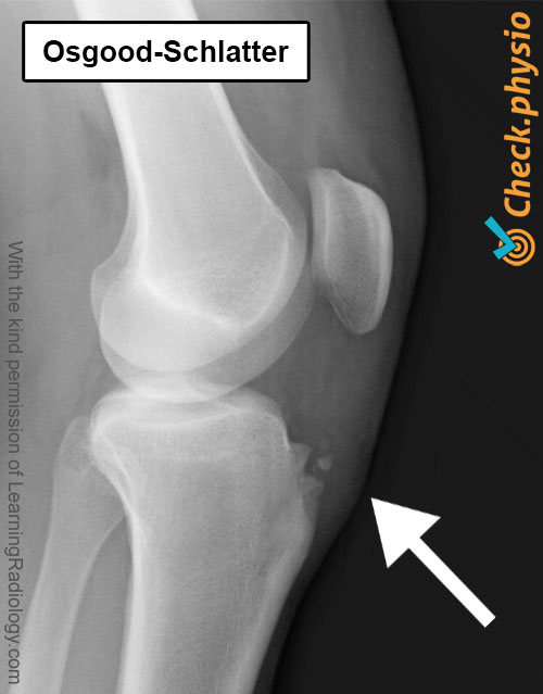 rodilla osgood schlatter radiografía